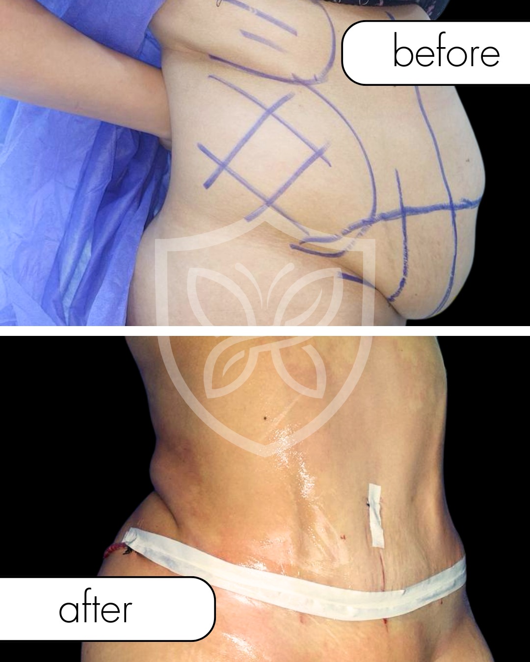 Body Contouring