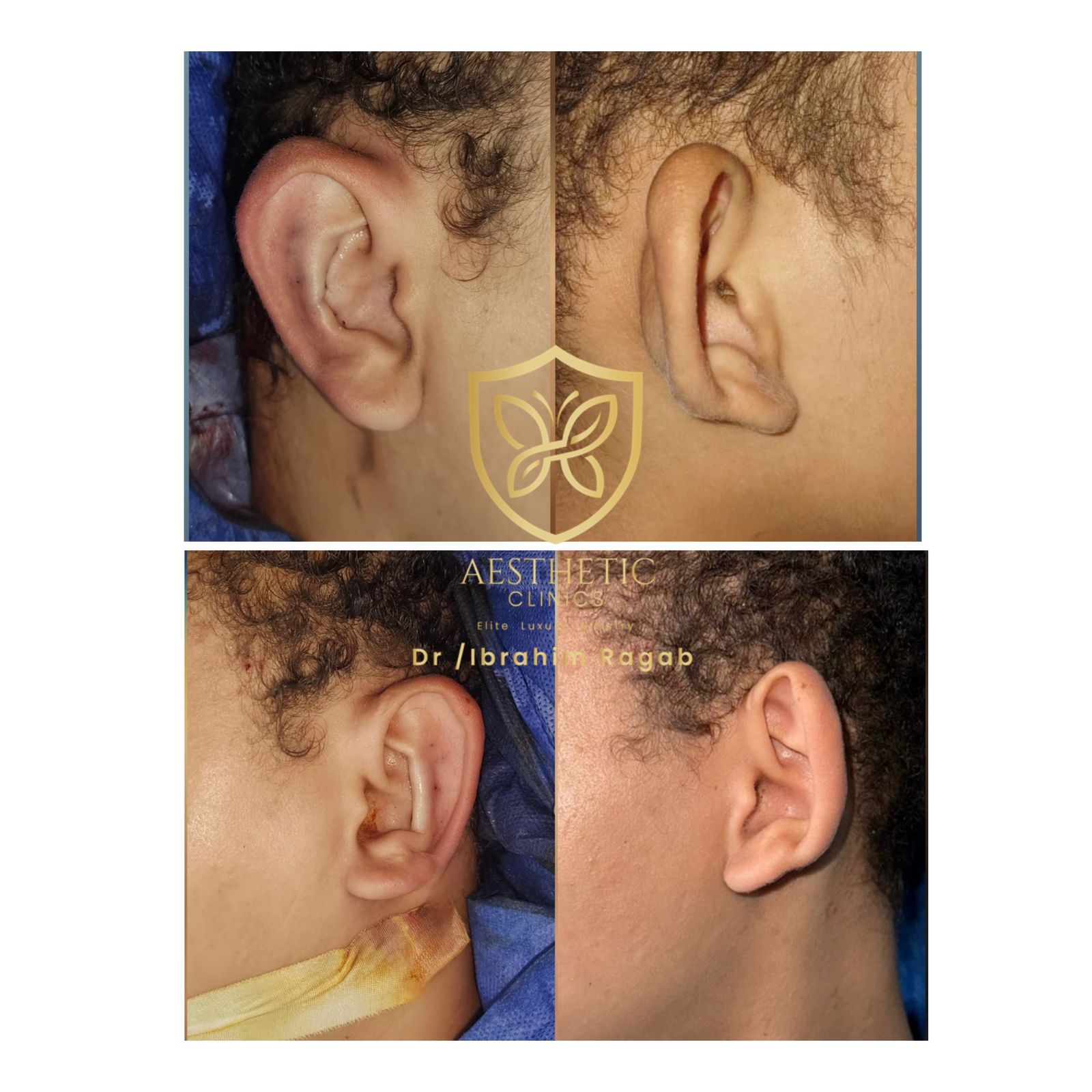 Ear Reconstruction