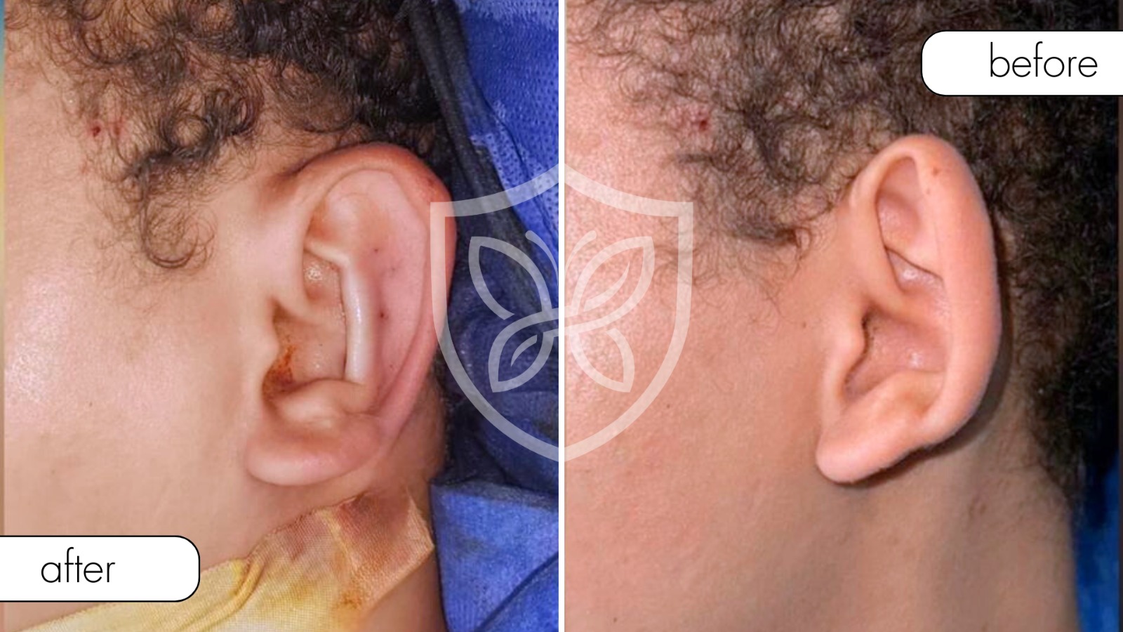 Ear Reconstruction